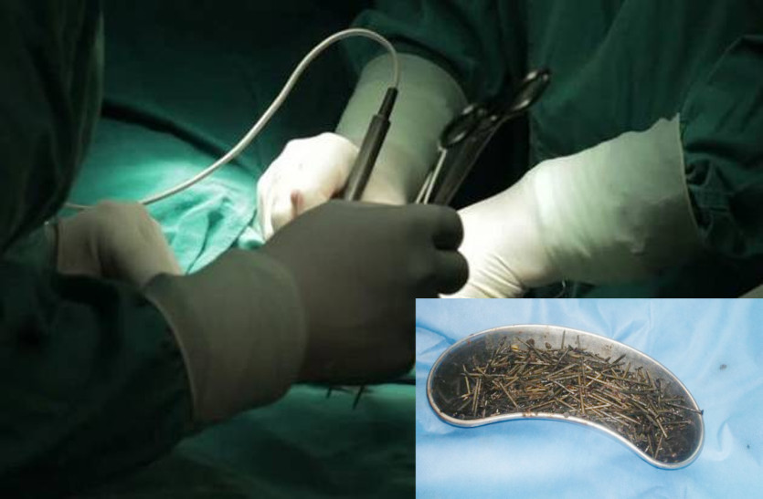 Iron Nails in Stomach