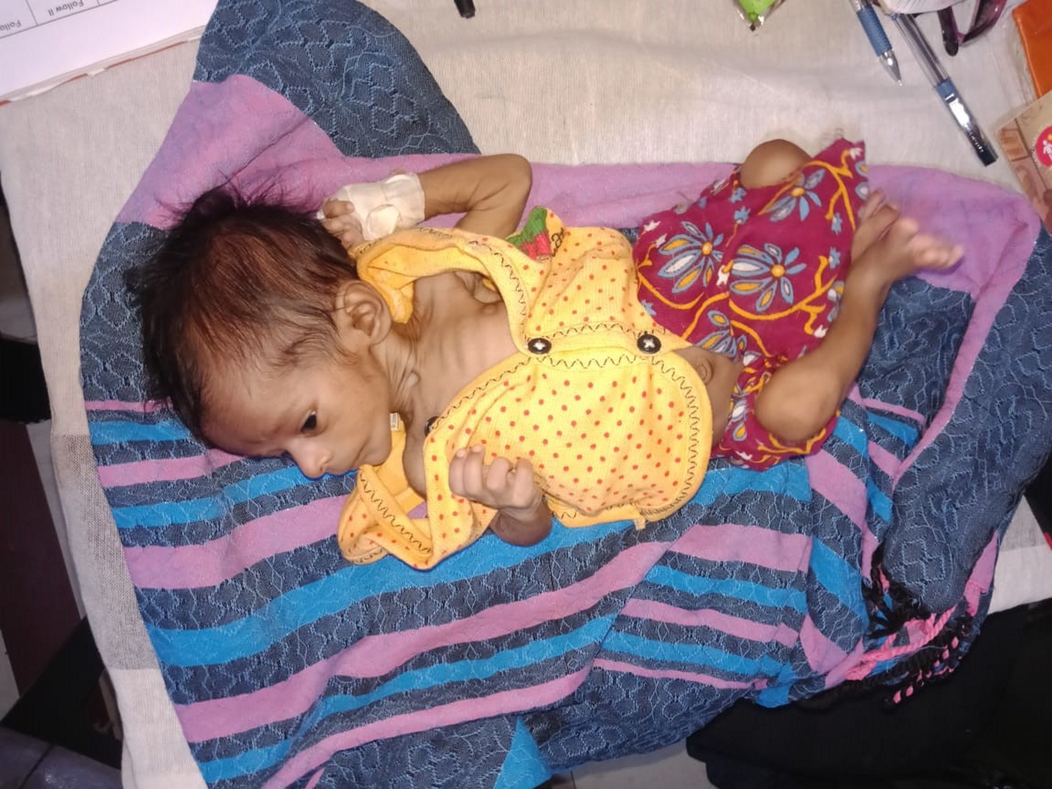 Mother brought malnourished child to NRC hospital
