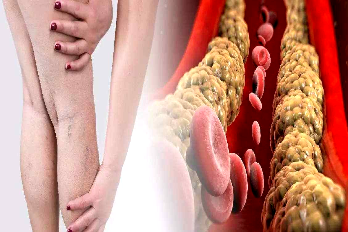 veins blockage treatment