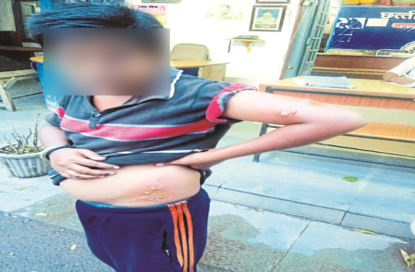 Burned of child from hot milk in Bilaspur Chhattisgarh