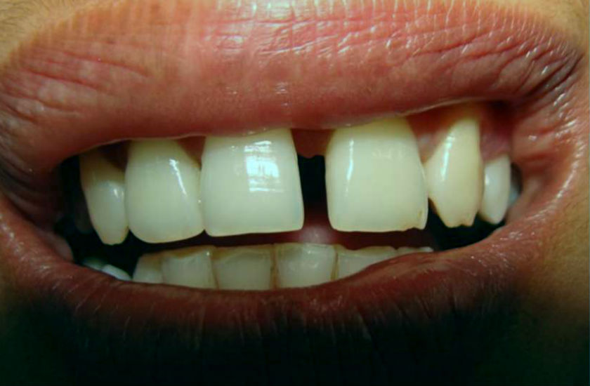 gap between teeth