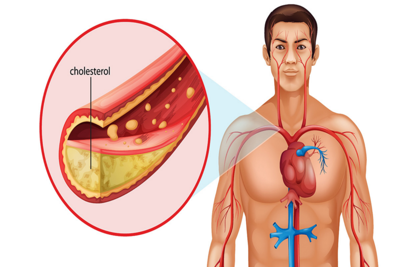 bad-cholesterol-is-the-enemy-of-your-health