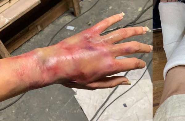 Taapsee Pannu Latest Photo injured hand game over shoot