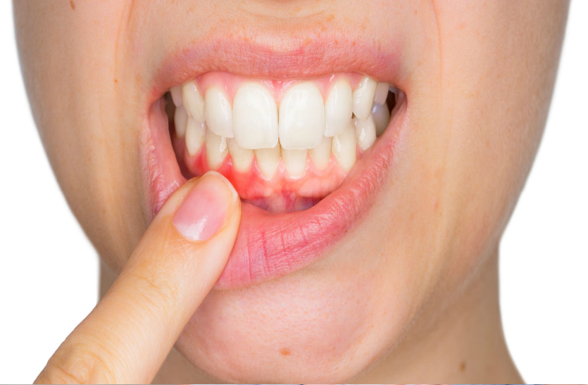 know-about-gingivitis