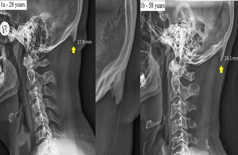 human skeleton is changing due to excess use of mobile phones