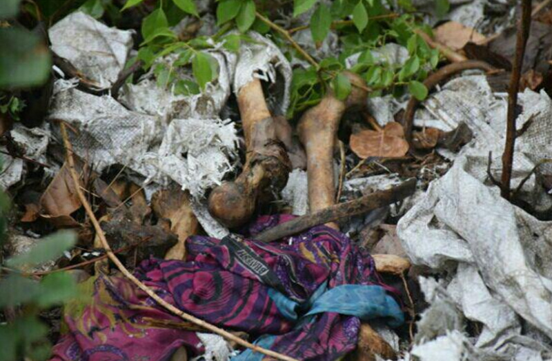 SKMCH Muzaffarpur Human Skeleton Case