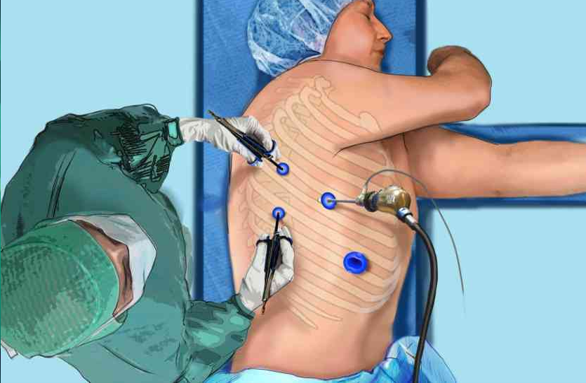 thoracoscopy-know-about-pulmonary-edema