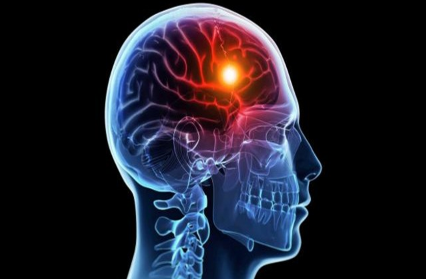 Brain Stroke: जानिए क्यों होता है ब्रेन स्ट्रोक, कैसे करें पहचान और उपचार