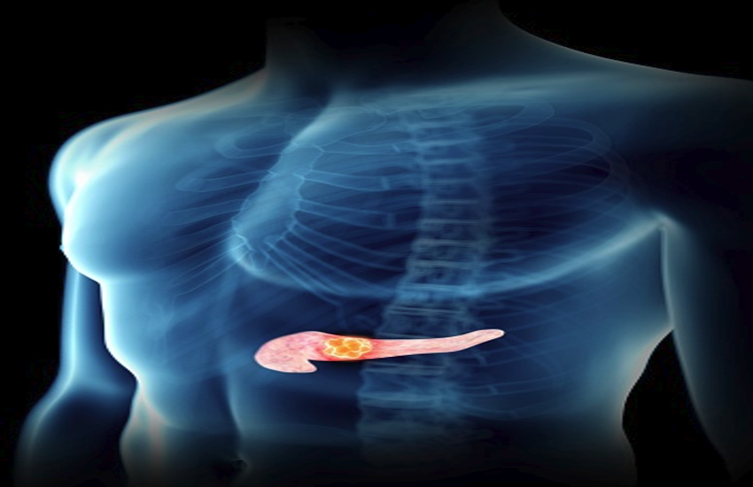 pancreas cancer care