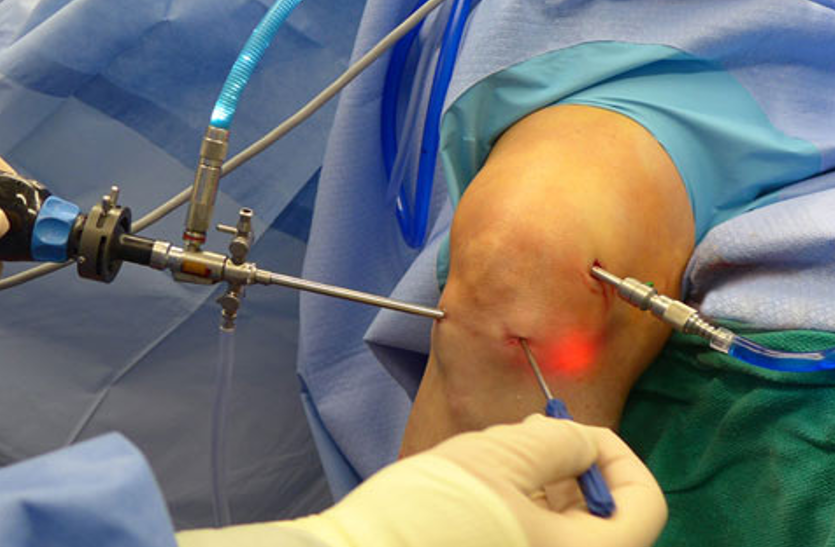 arthroscopy-surgery-what-to-expect-after-knee-arthroscopy-surgery