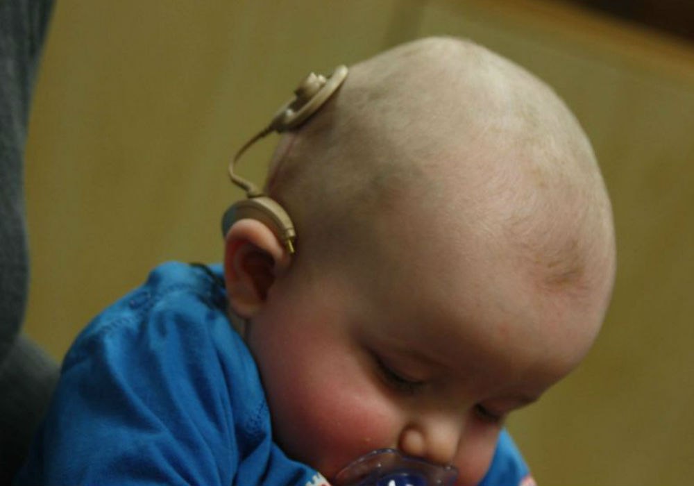 Cochlear implant Surgery 