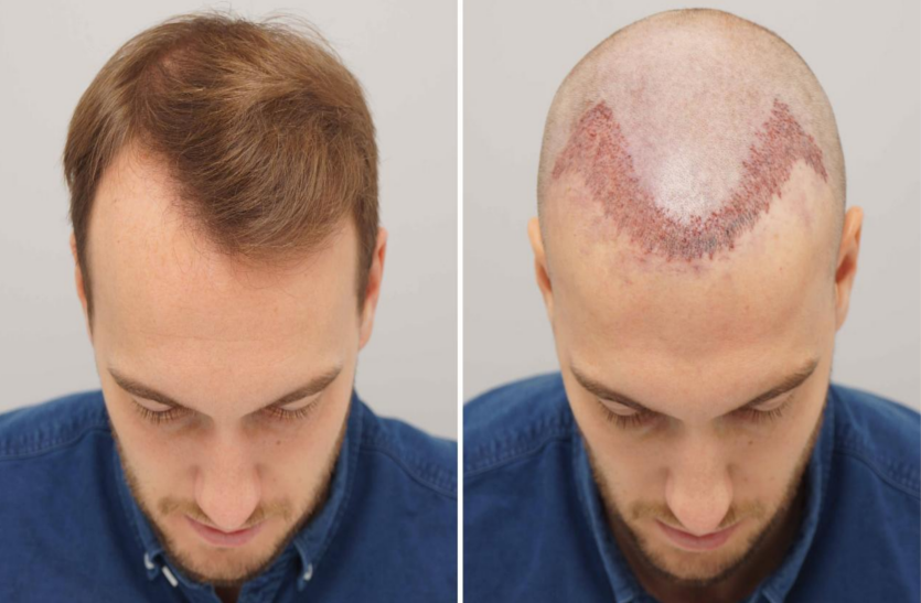 Hair Transplant tips: