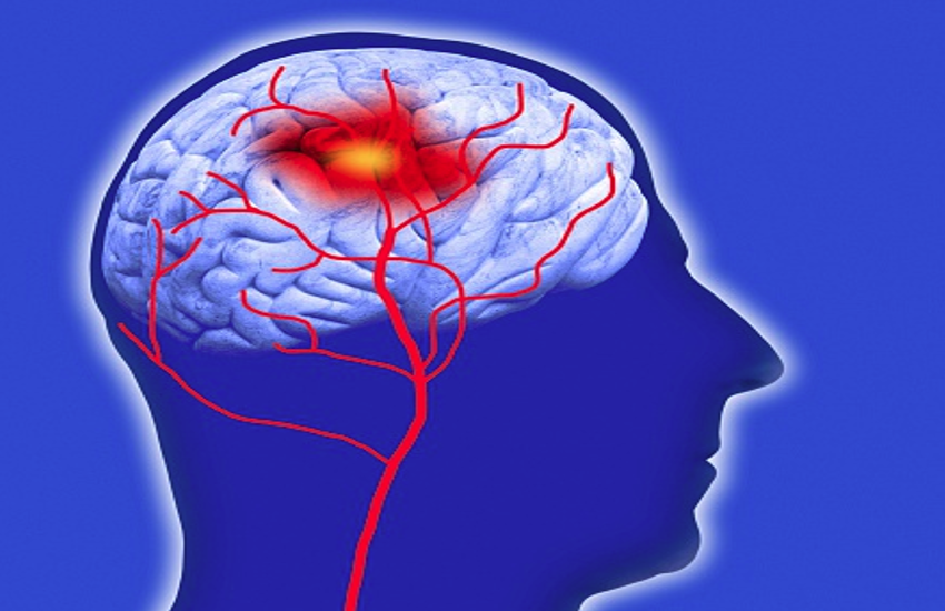 brain stroke