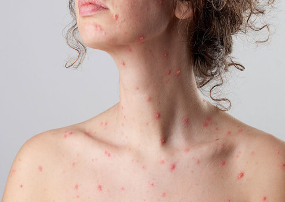 keep-these-things-in-mind-if-you-get-chickenpox