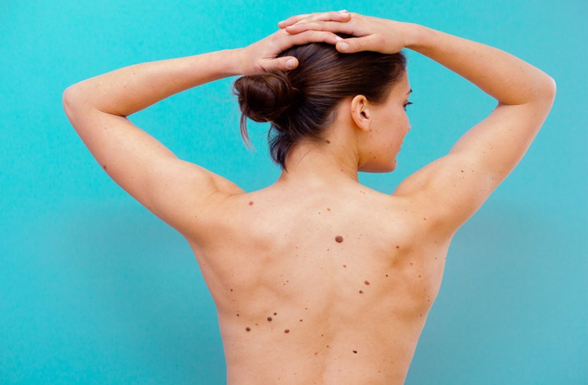 skin-cancer-causes-symptoms-and-treatment