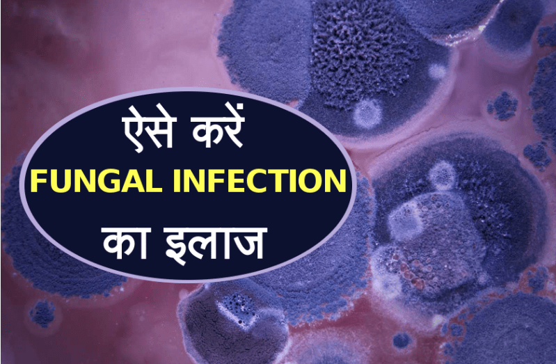fungal infection