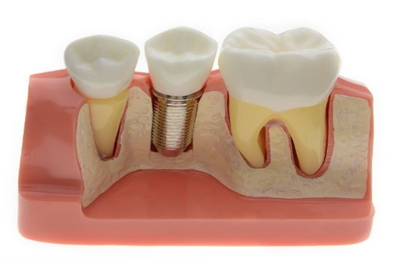 जानिए दांतों से जुड़ी कॉर्टिकल इम्प्लांट तकनीक के बारे में