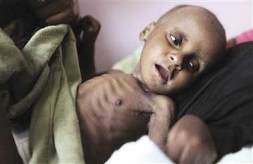 Bite of malnutrition among tribal innocent