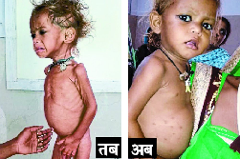 Satna kuposhan Childhood smile from nutrition to severely malnourished