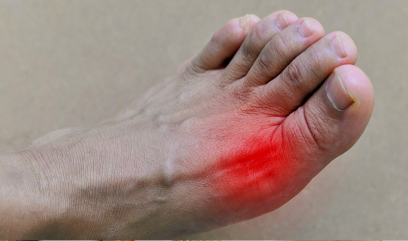 शरीर में यूरिक एसिड बढ़ने से होती हैं ये समस्याएं