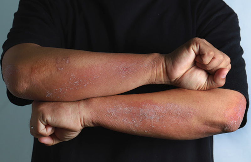 नमी के मौसम में फैल सकता है स्किन इंफेक्शन, एेसे करें बचाव