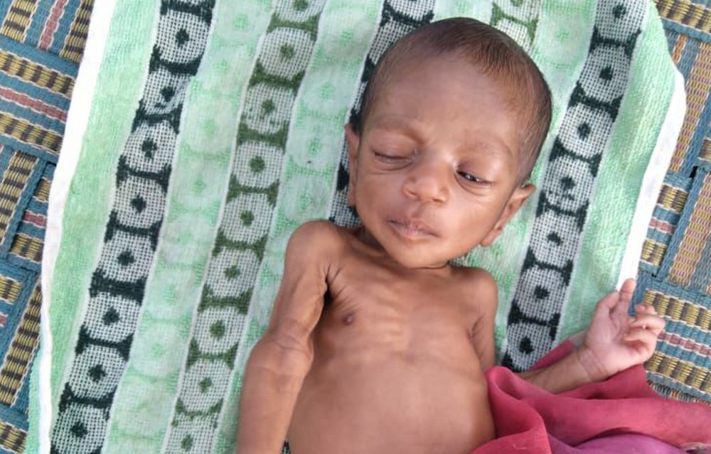  Like Sumailia, this district of MP is fighting the battle of malnutrition