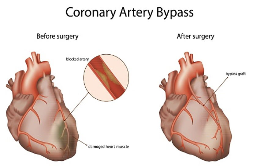 Coronary Artery Bypass Grafting: ब्लाकेज दूर करने में ज्यादा सफल