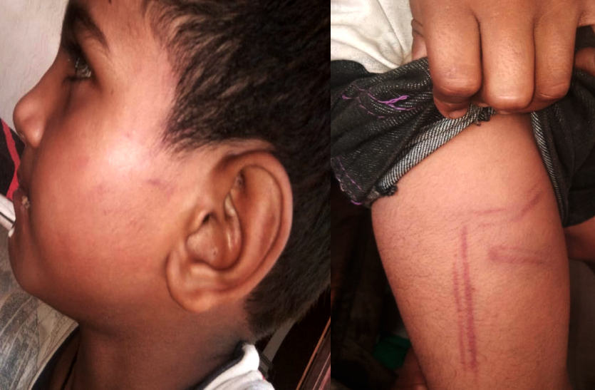 कक्षा दो में पढऩे वाले मासूम बच्चे को शिक्षक ने बेहरमी से पीटा, शरीर पर पड़े लाल निशान