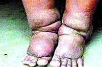 सरकारी प्रयास के बाद भी जिले में मिले फाइलेरिया के 448 मरीज