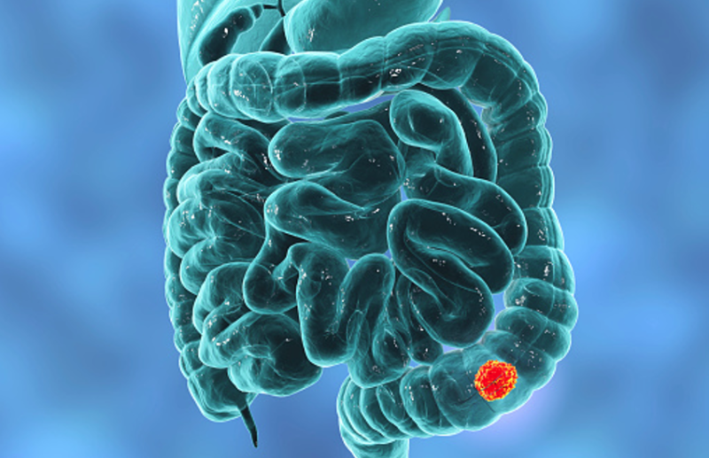 Pre - Diagnostic Colonoscopies Is Useful In Colon Cancer Treatment
