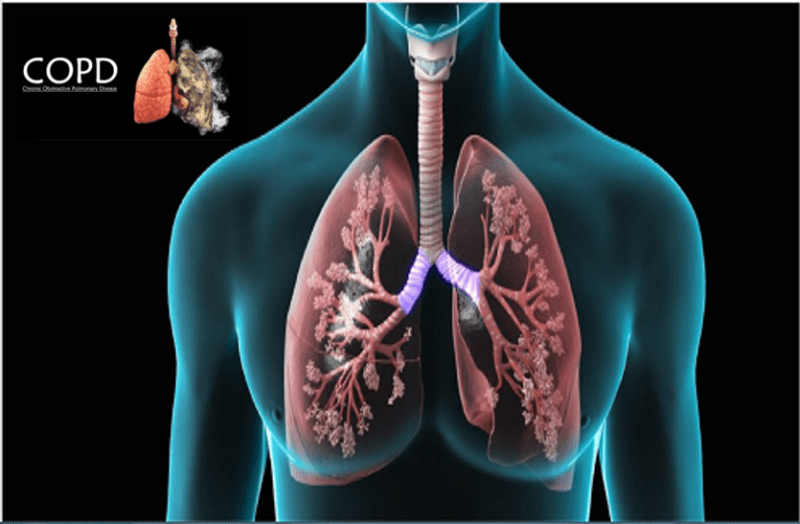 COPD disease: जानिए फेफड़ों से जुड़ी इस गंभीर बीमारी के बारे में