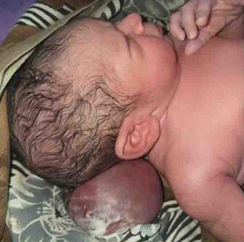 कानपुर के नवजात को वाराणसी से मिला नया जीवन, इस जन्मजात रोग का हुआ सफल इलाज