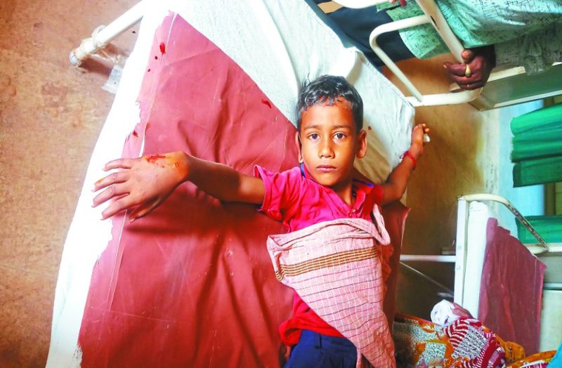 8 साल के बच्चे को कुत्ते ने काटा, जिला अस्पताल में नहीं है एंटी रेबीज इंजेक्शन