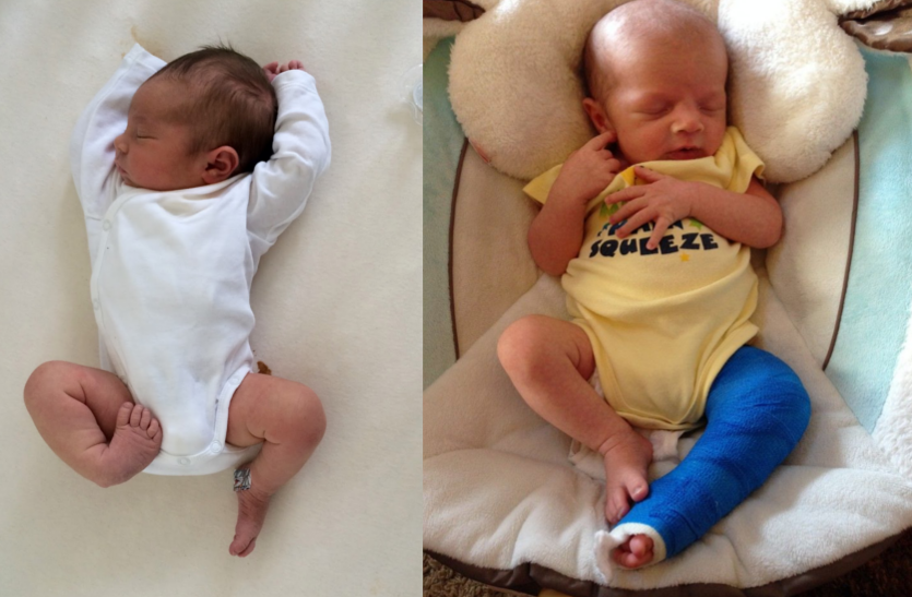 क्लबफुट की समस्या में जन्म से ही शिशु के पैर के पंजे मुड़े होते हैं, जानें इसके बारे में