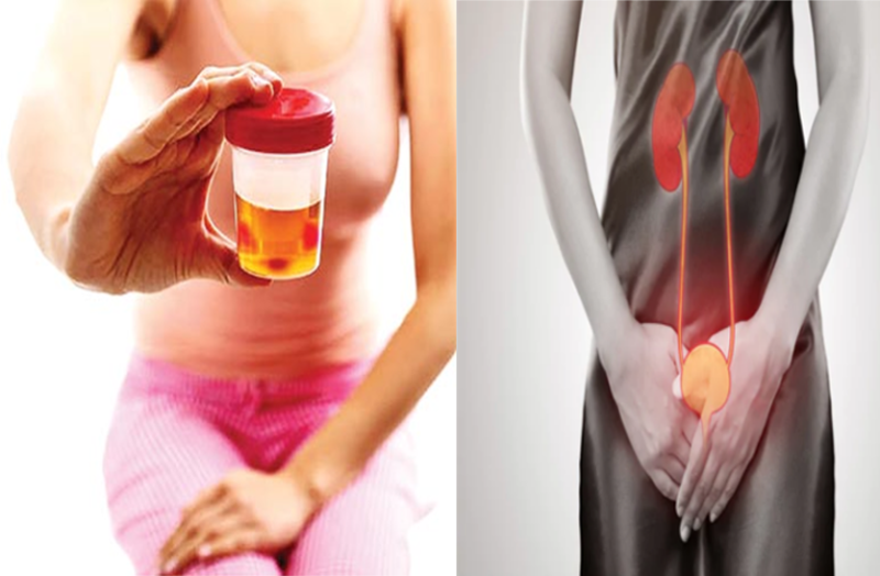 यूरिन इंफेक्शन के लिए फायदेमंद है ये घरेलू नुस्खे