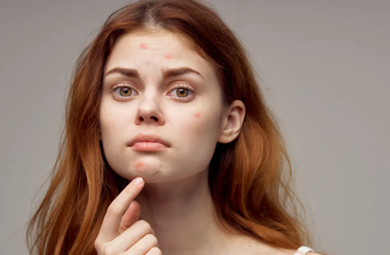 खान-पान और तनाव भी हैं मुंहासों का कारण