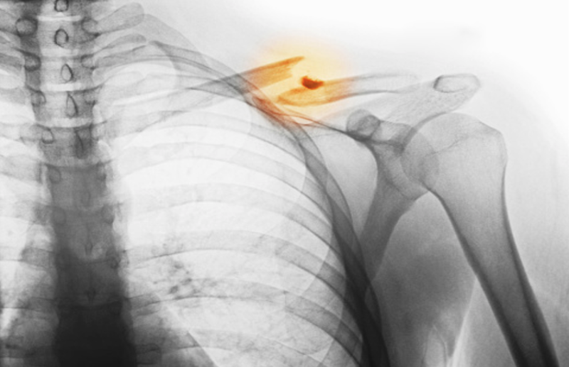 World Osteoporosis Day: Risk Factor, causes, Symptoms And Treatment