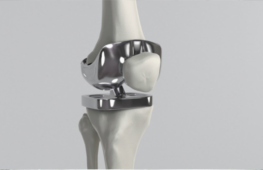 knee Arthroplasty Is Good To Prevent knee Problems