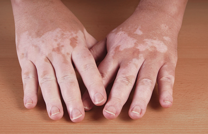 Vitiligo Treatment: Know About Leucoderma Homeopathic Treatment