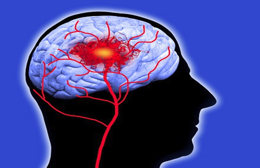 World Stroke Day: Know Stroke Risks, Symptoms And Treatment