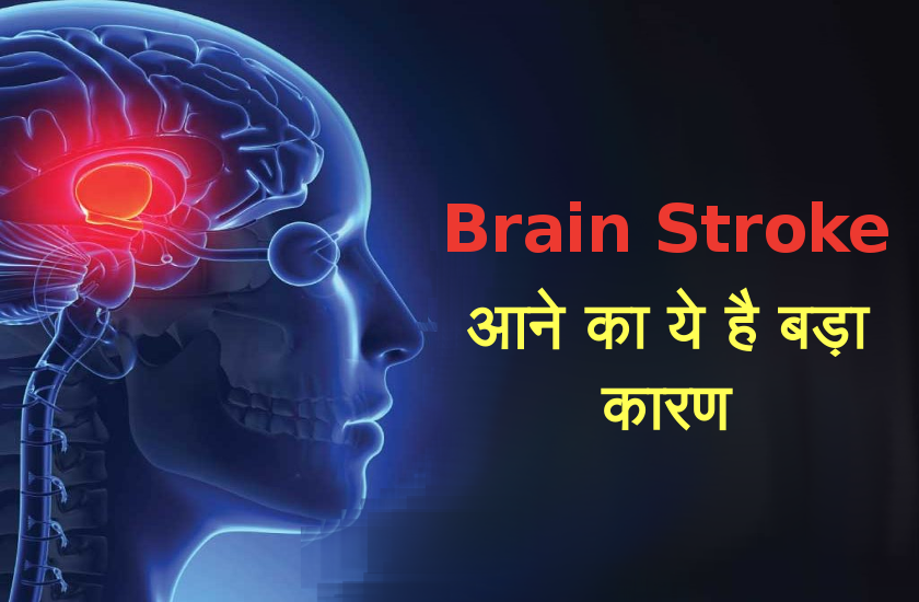 brain stroke