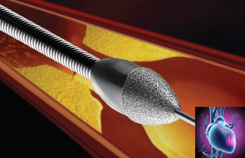 रोटा एबलेशन तकनीक से दूर हाेती है हार्ट ब्लॉकेज की समस्या