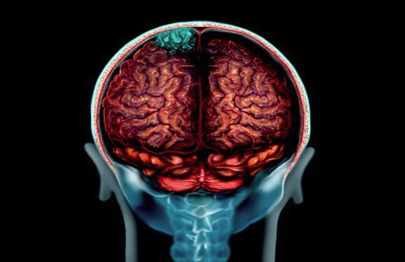 All brain tumors are not cancer, Know the basic facts