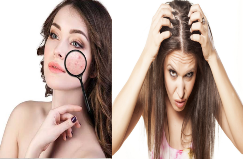 जानिए रूखी त्वचा, मुहांसों, झाइयों, झड़ते बालों और डैंड्रफ के लिए उपचार