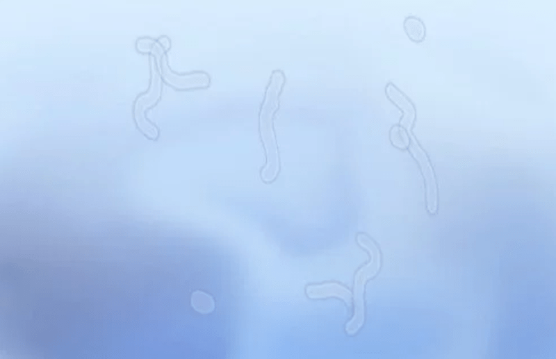 you should know about Eye floaters - Symptoms and causes