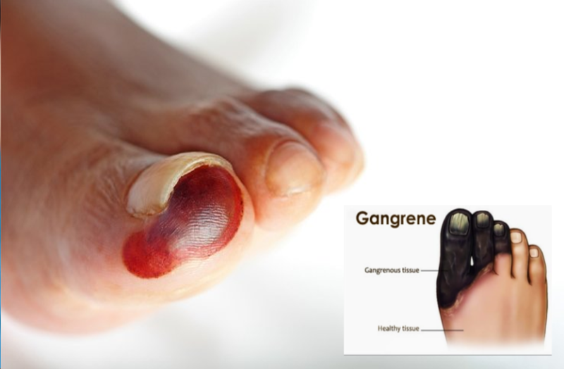 चोट लगने पर ज्यादा टाइट न बांधें पट्टी, हो सकता है गैंगरिन