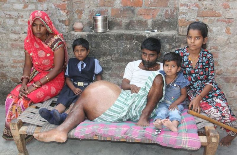 जिंदगी दोजख: अस्थि कैंसर से हाथी सा हुआ पांव, खाट पर पड़े रहना मजबूरी