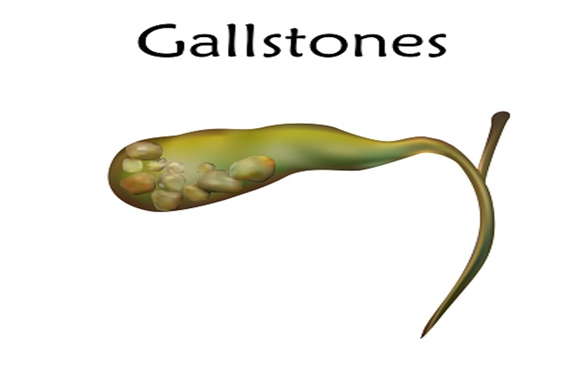 Gallbladder Stones Symptoms, Causes and Treatment