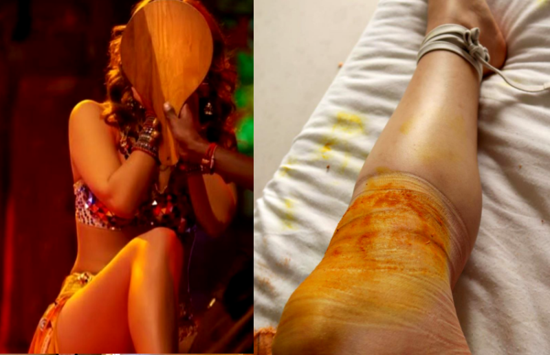 Ex बिग बॉस कंटेस्टेंट एक्ट्रेस को लगी घुटने में चोट, दोस्त के कहने पर किया ये घरेलू उपचार