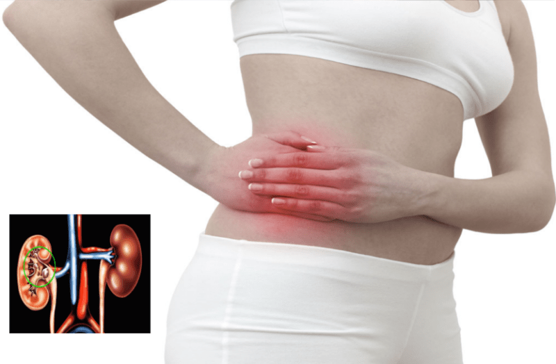 अगर आपको पथरी की समस्या है तो जान लें ये बातें, तुरंत होगा फायदा